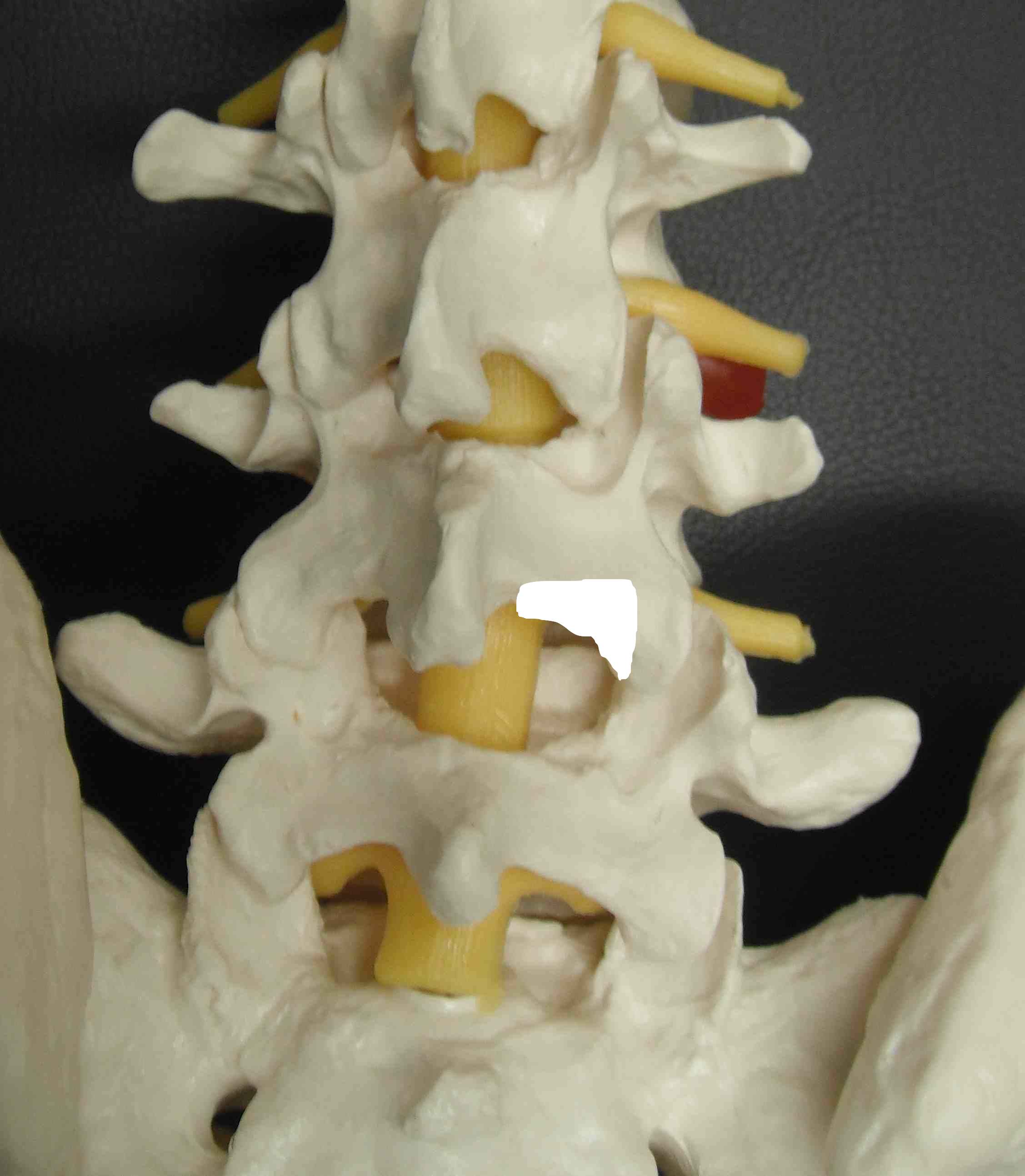 Lumbar Spine Hemilaminotomy
